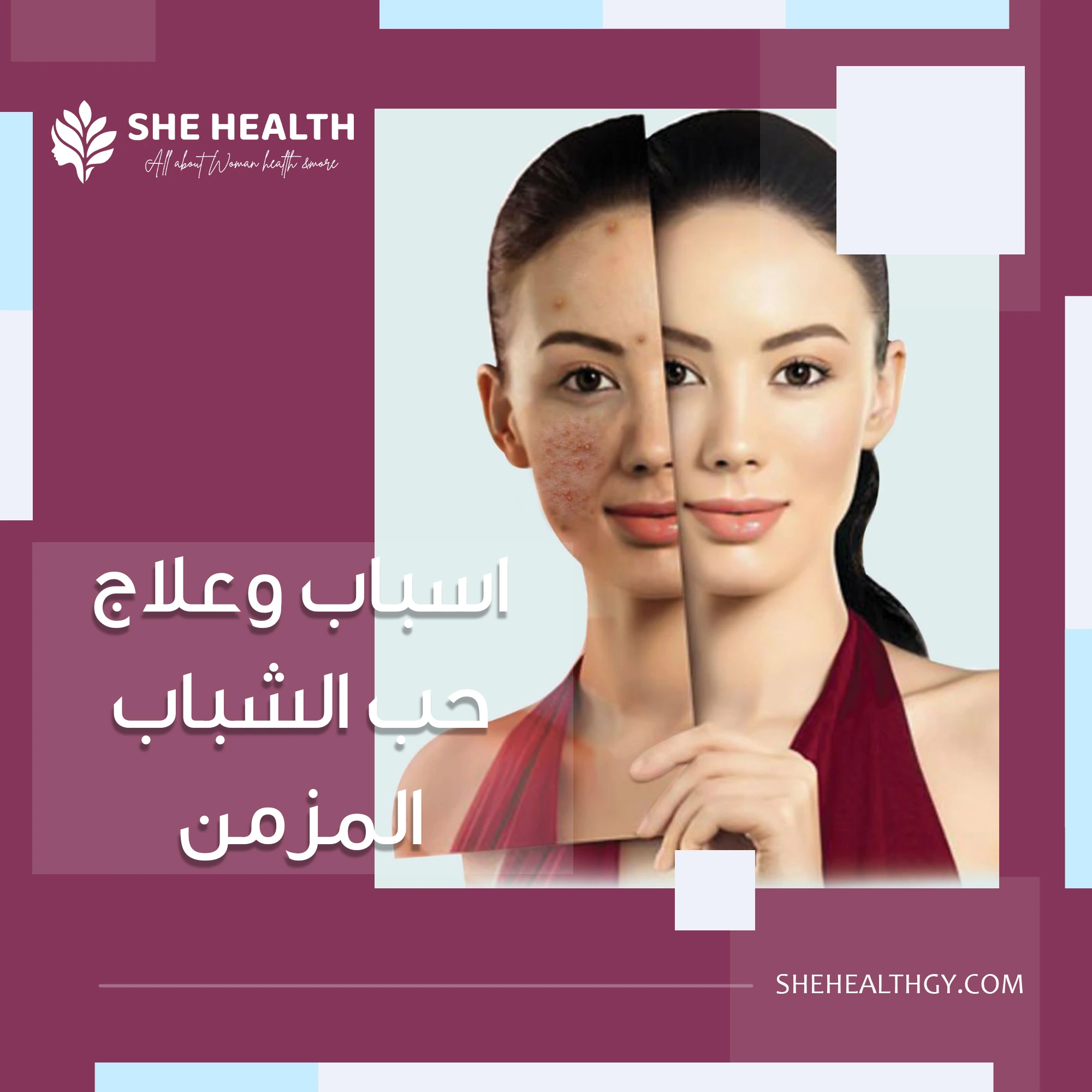 اسباب وعلاج حب الشباب المزمن
